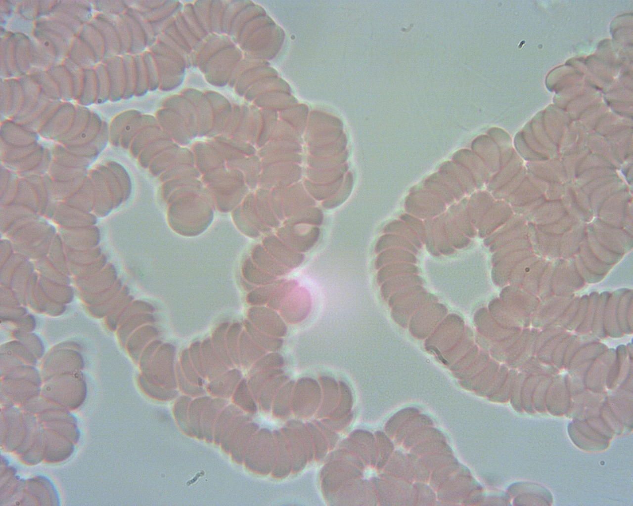 Obraz spod mikroskopu, widać krwinki czerwone połączone w rulony jak makarony. 