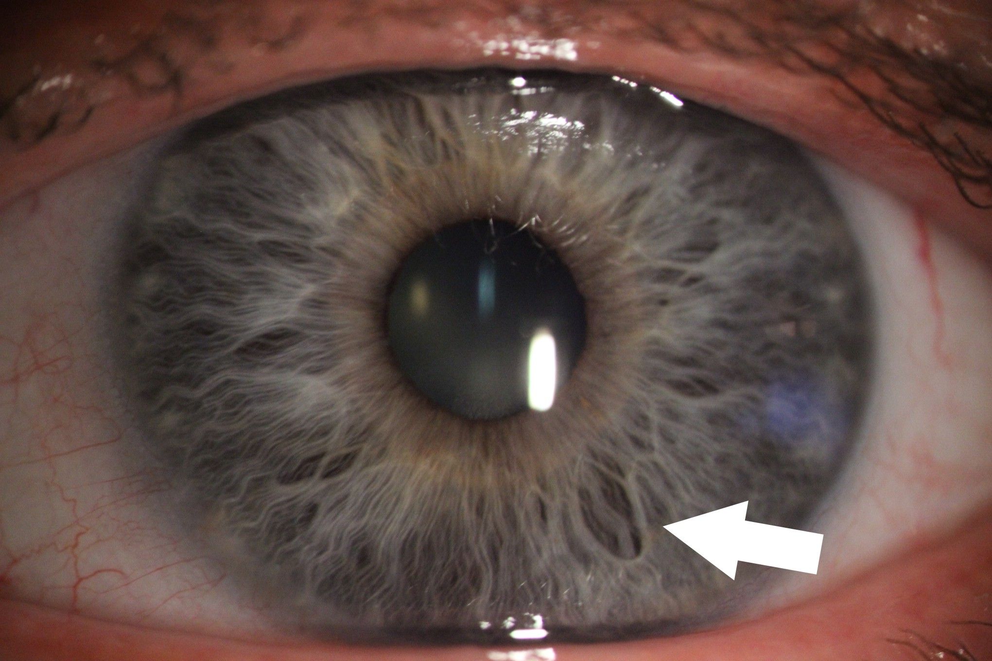 Zdjęcie tęczówki oka z aparatu podczas badania. Jest zaznaczona strzałka wskazująca zmiany na tęczówce. 