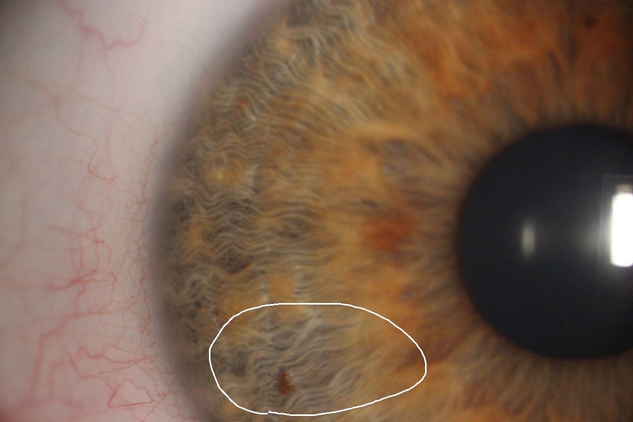Zdjęcie części tęczówki oka. Jest zaznaczona w kółeczko plamka brązowa na tęczówce wskazująca na problem z wątrobą. 