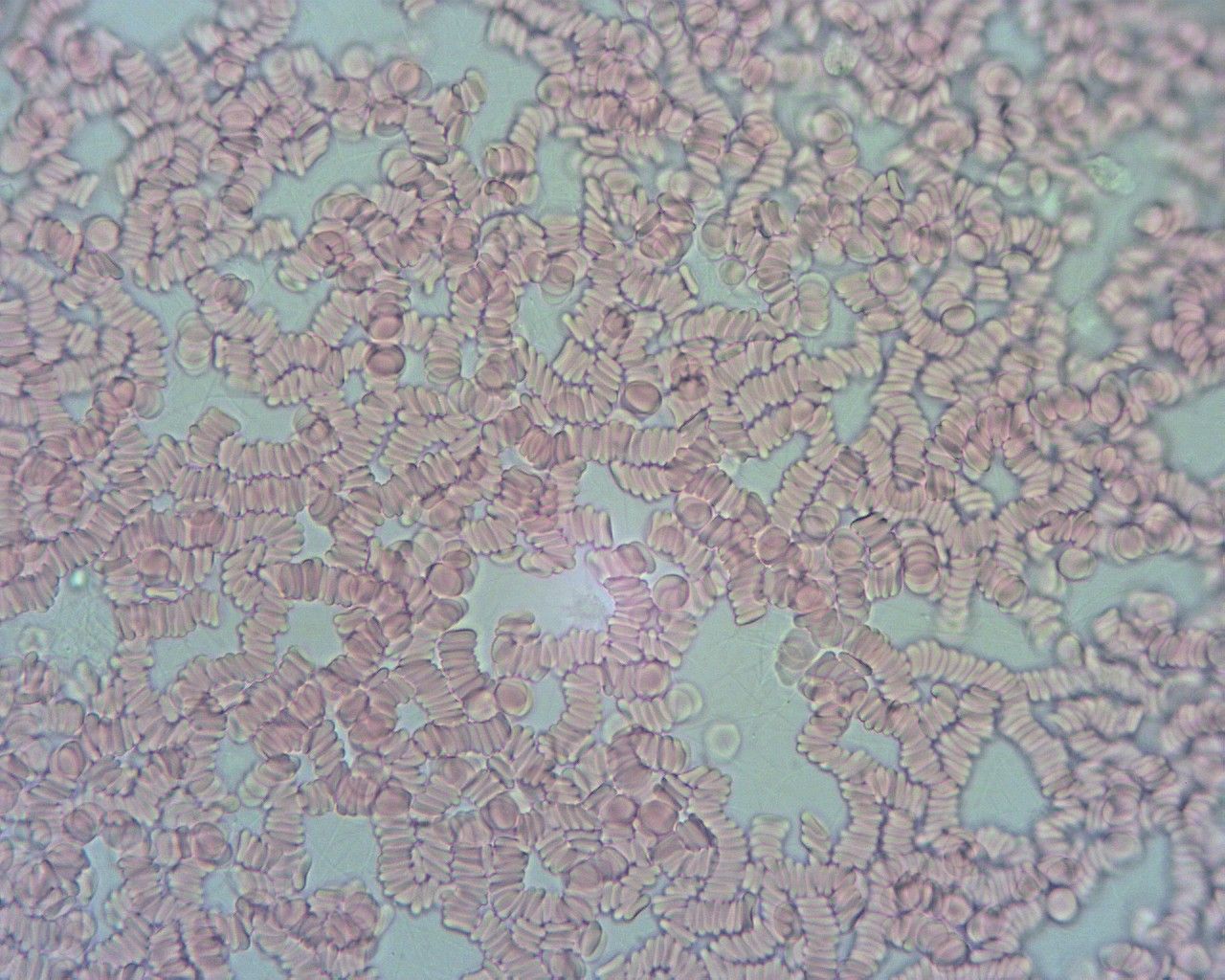 Obraz krwi spod mikroskopu. Krew jest bardzo gęsta i posklejana. 