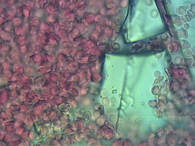 Krew pod mikroskopem. Widać duży kawałek opiłków szkiełka pośród krwinek