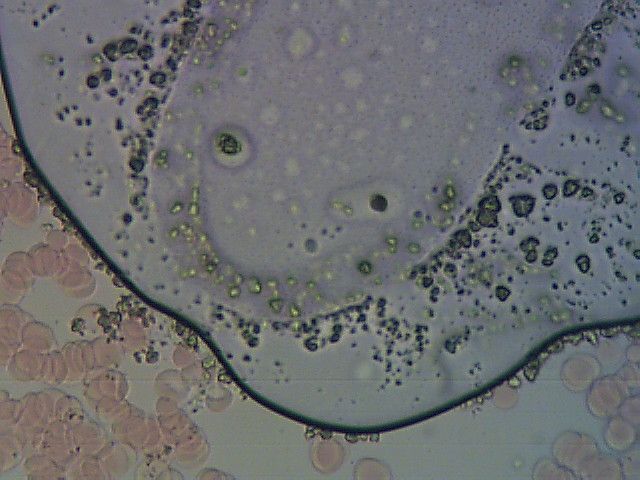 Obraz krwi spod mikroskopu. W dużej części widać bąbelek powietrza z brudami na szkiełku. 