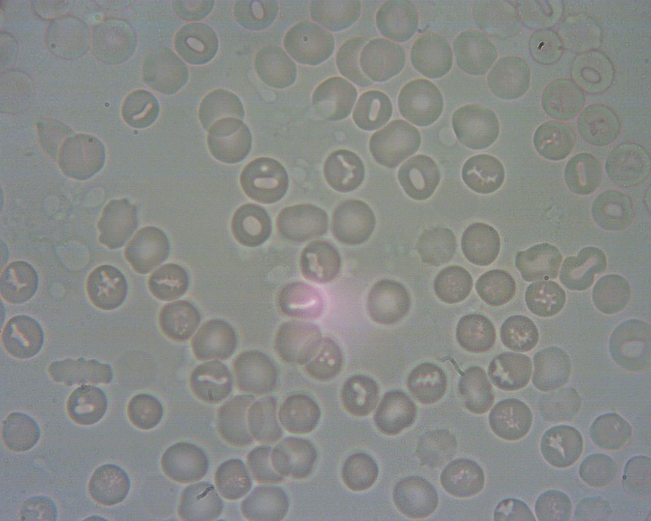 Obraz krwinek spod mikroskopu. Na krwinkach i pomiędzy nimi widać bąbelki wskazujące na przerost grzybów. 