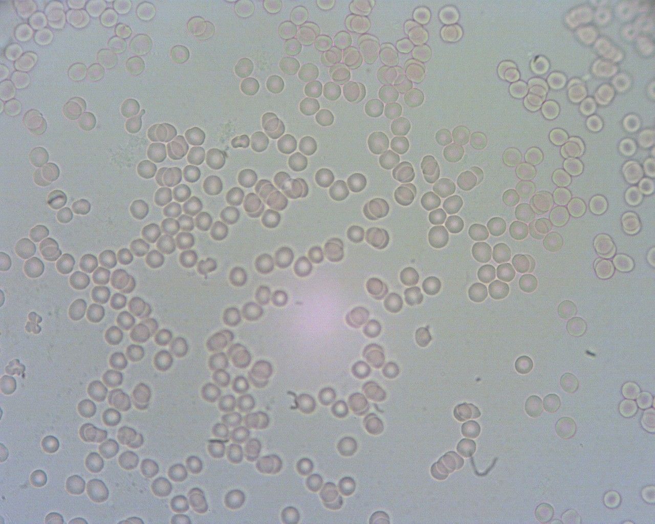 Zdjęcie krwinek spod mikroskopu. Widać niedożywione krwinki.