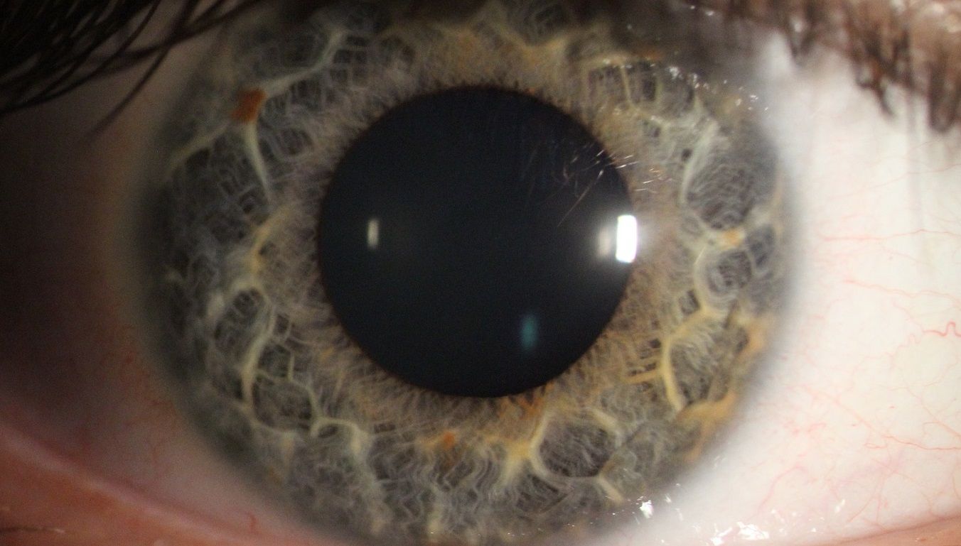 Tęczówka oka koloru niebieskiego z dużą źrenicą. 