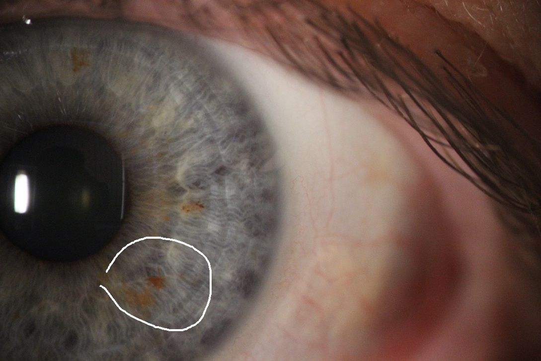 Zdjęcie kolejnej tęczówki oka wykonane podczas badania. Jest zaznaczone kółeczko w celu pokazania opisanych w tekście zmian