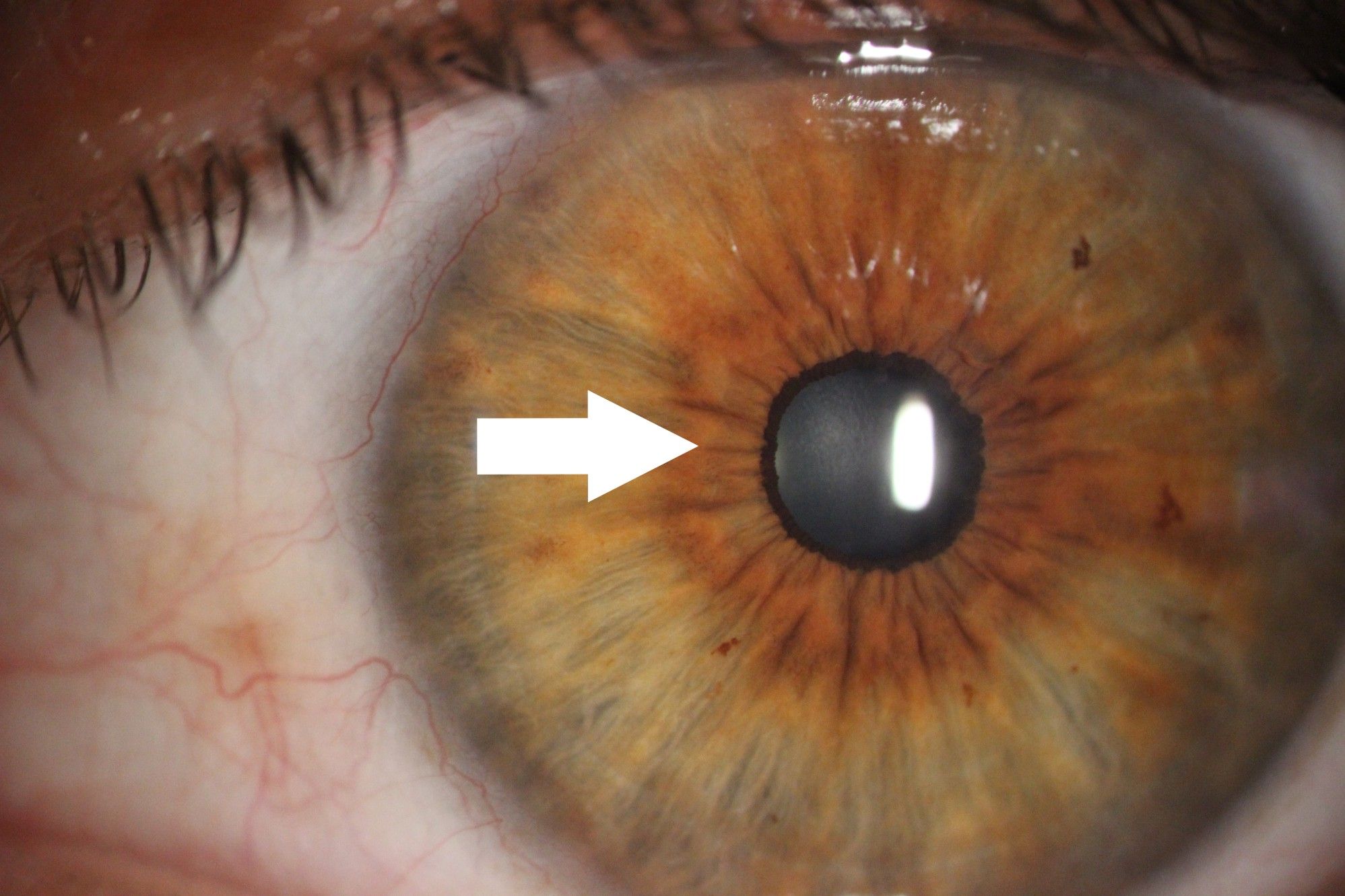 Zdjęcie tęczówki oka z aparatu podczas badania. Oko koloru brązowo żółtego. Jest zaznaczona strzałka wskazująca zmiany na tęczówce. 