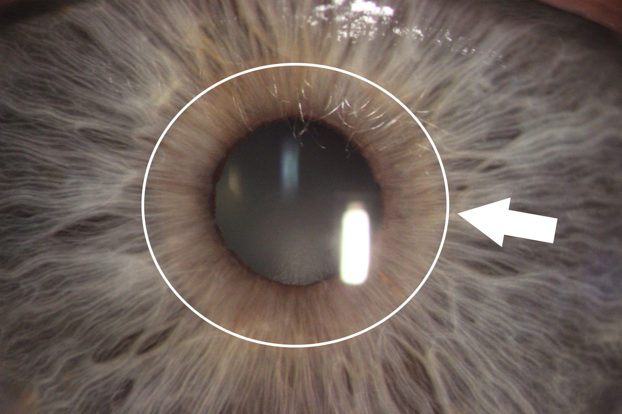 Tęczówka oka zdjęcie z badania. Na zdjęciu widać zmiany wskazujące na niedokwaszanie żołądka