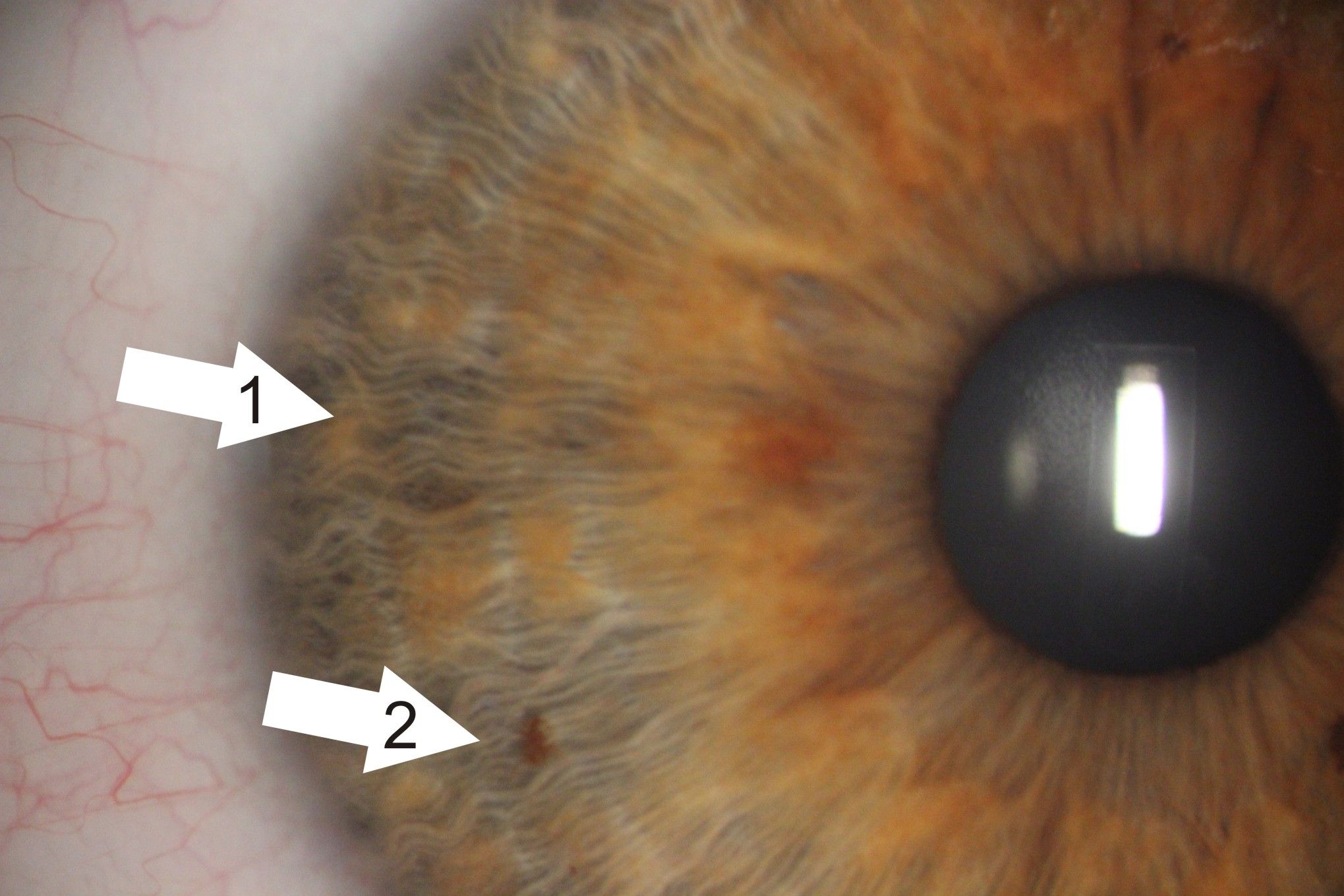 Zdjęcie tęczówki oka z aparatu podczas badania. Są zaznaczone strzałki wskazujące zmiany na tęczówce. 