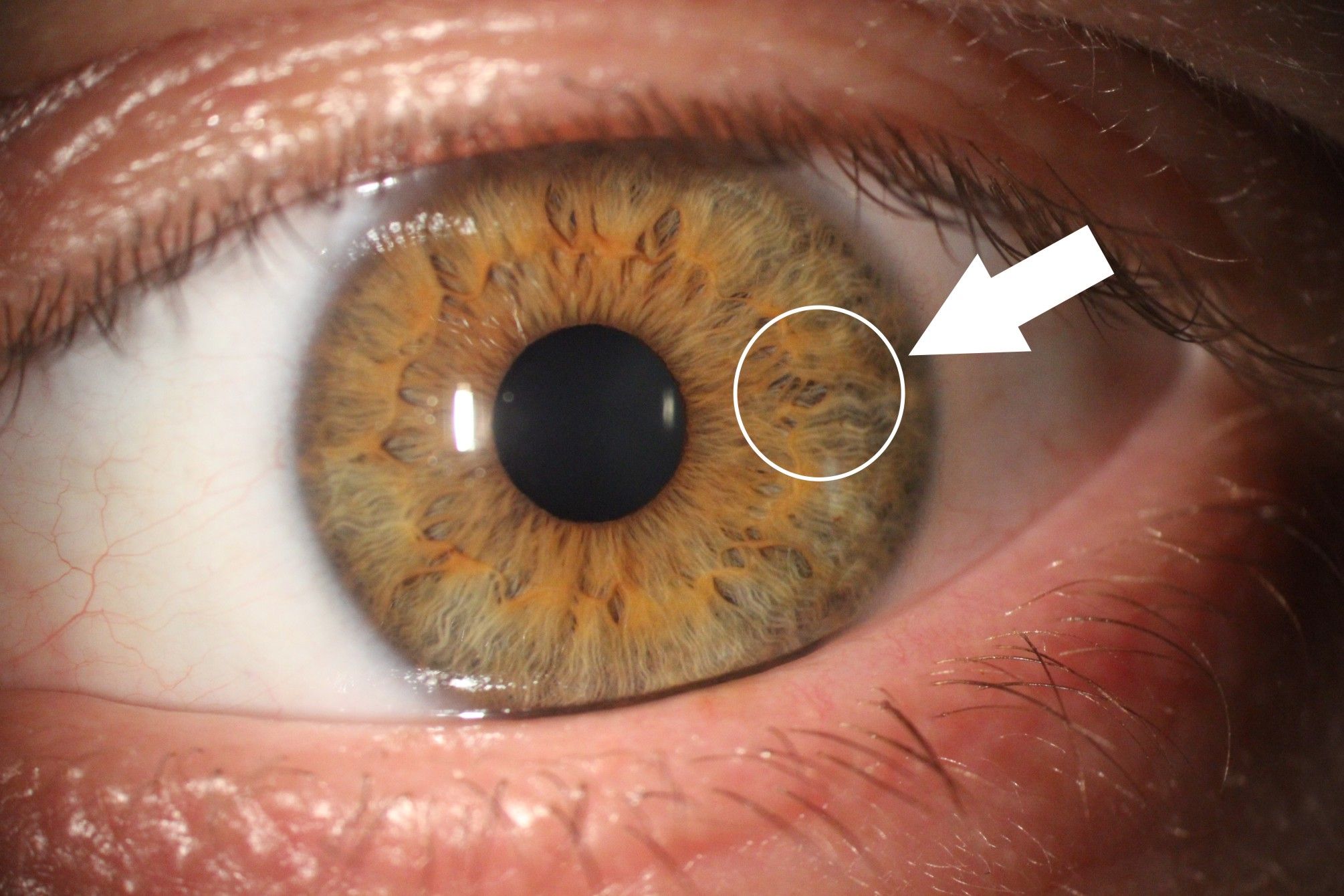 Zdjęcie tęczówki oka z aparatu podczas badania. Są zaznaczone strzałki i kółeczko wskazujące zmiany na tęczówce. 