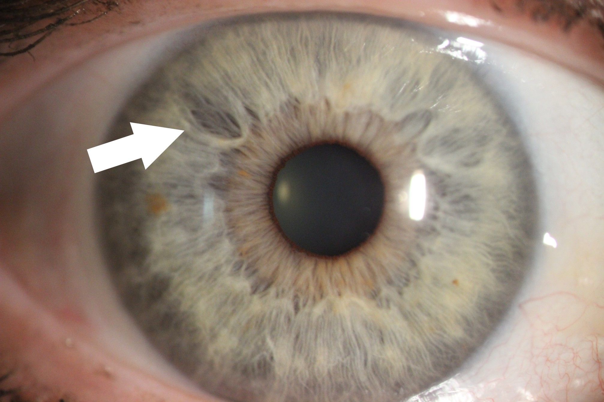 Zdjęcie tęczówki oka z aparatu podczas badania.Jest zaznaczona strzałka pokazująca zmiany na tęczówce. 