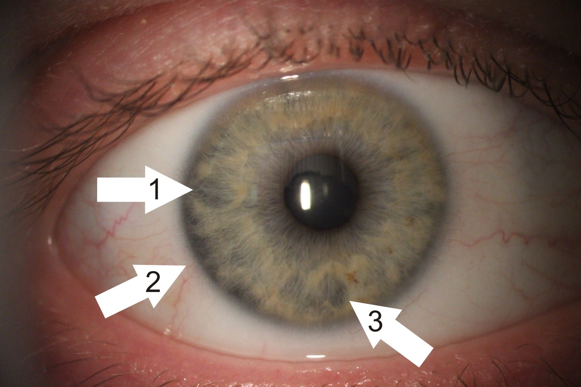 Zdjęcie tęczówki oka. Są na nim zaznaczone trzy białe strzałki wskazujące poszczególne miejsca na tęczówce. 