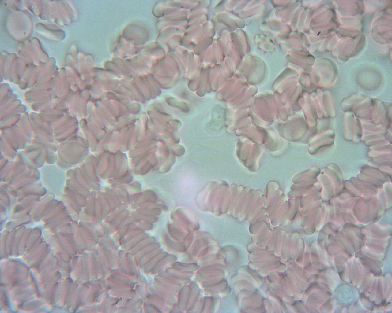 Obraz krwinek czerwonych pod mikroskopem. Widać polepione krwinki