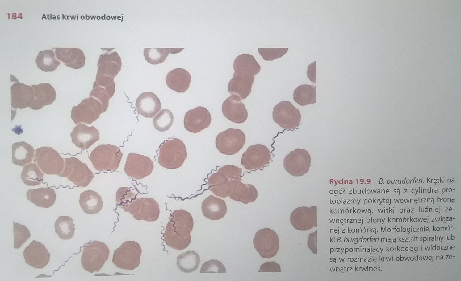 Zdjęcie a altasu krwi obwodowej. Widać obraz krwi pod mikroskopem i krętki bakterii borrelii. 