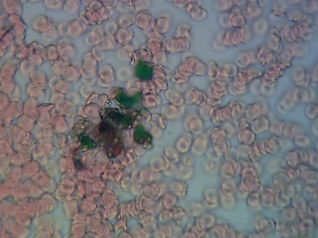 Obraz krwi pod mikroskopem. Widać polepione erytrocyty oraz przebarwienia zielono-czarne będące artefaktami na szkiełku. 