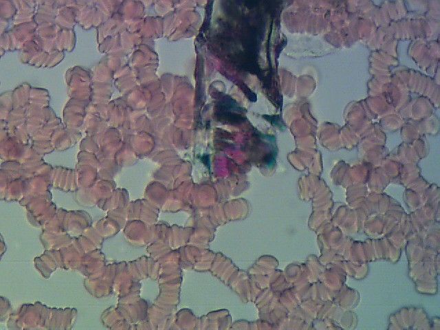 Obraz krwi pod mikroskopem. Widać krwinki oraz przebarwienia czarno-fioletowe będące artefaktami na szkiełku. 
