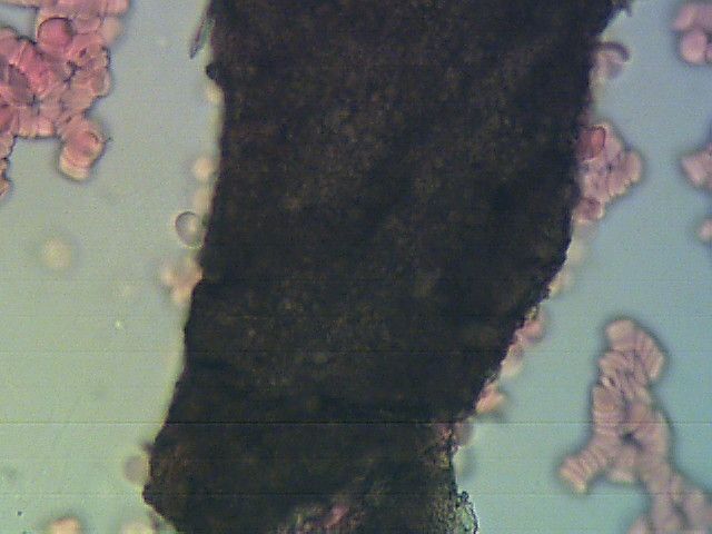 Obraz krwi pod mikroskopem. Widać duży kawałek brudu zajmujący większość obrazu