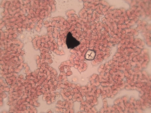 Obraz krwi pod mikroskopem. Opórcz krwinek widać czarne zabrudzenia