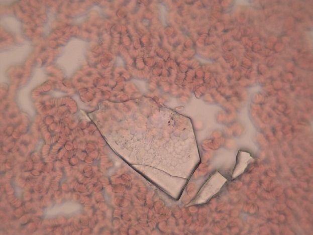 Obraz krwi pod mikroskopem. Widać krinki czerwone a pomiędzy nimi opiłki szkiełka. 